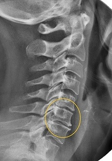 Narrowing of the intervertebral space on x-ray