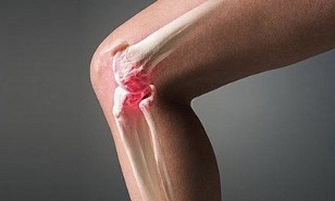 how arthritis differs from arthrosis