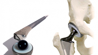 arthroplasty of the hip joint for arthrosis