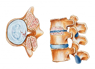 Osteochondrosis