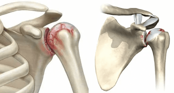what does arthrosis of the shoulder joint look like