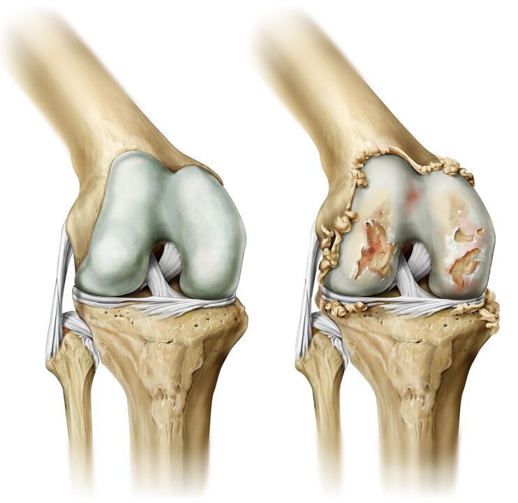 what does arthrosis look like 