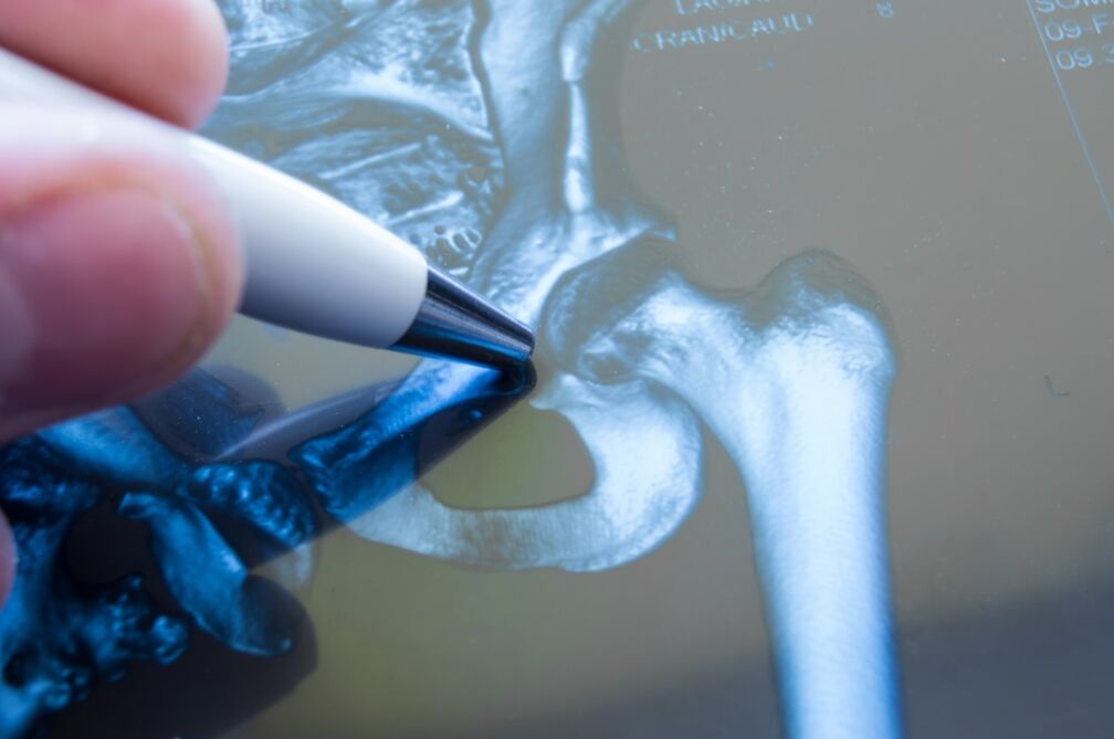 Arthrosis of the hip joint on the radiograph