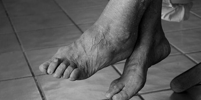 ankle arthrosis