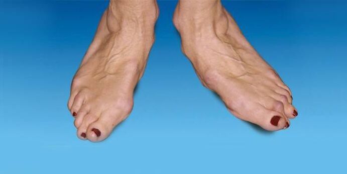 deformity of the foot with ankle arthrosis
