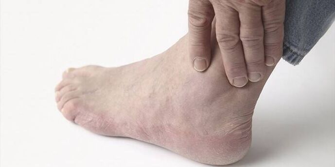 pain in ankle arthrosis