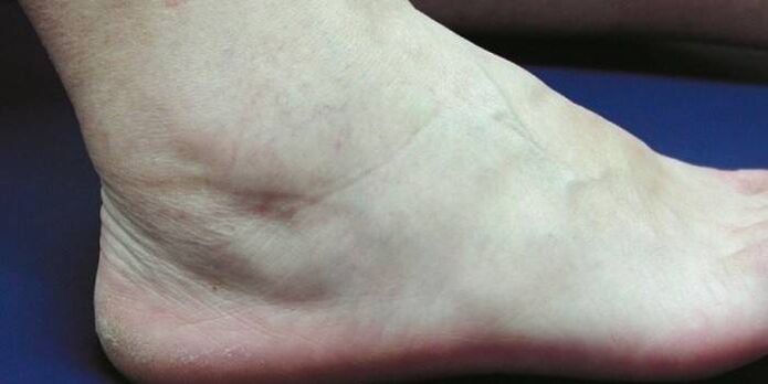 swelling of the ankle with arthrosis