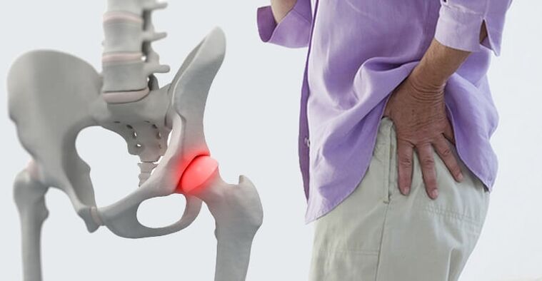 pain in the hip area - a symptom of arthrosis of the hip joint