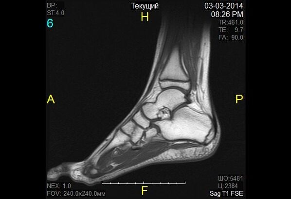 ankle image for arthrosis