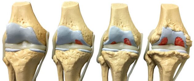 joint damage at different stages of development of ankle arthrosis