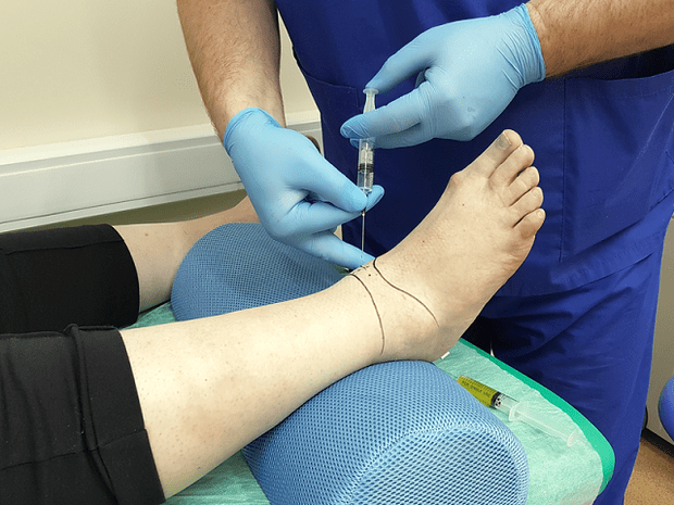 puncture for arthrosis of the ankle joint
