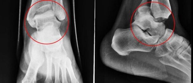 radiography for ankle arthrosis