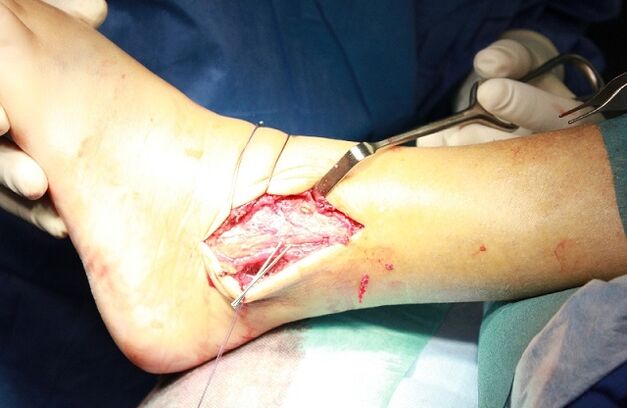 surgery for ankle arthrosis