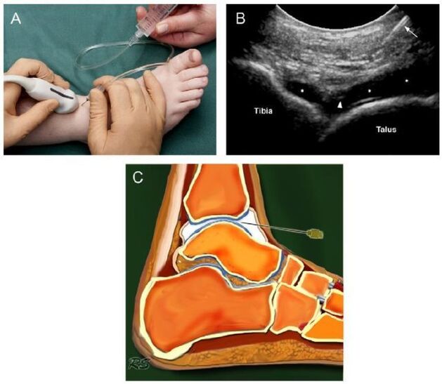 ultrasound of the ankle with arthrosis