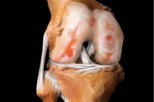 damage to the knee joint with arthrosis