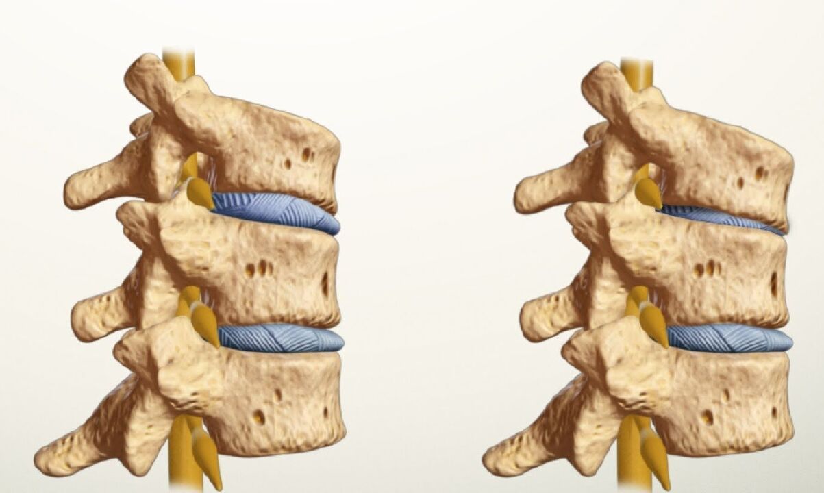 healthy and sick spine with lumbar osteochondrosis