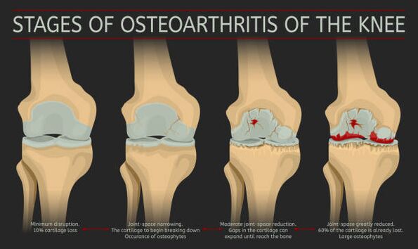 development of joint arthrosis
