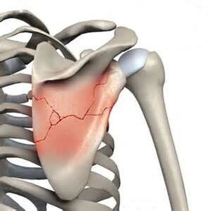 A scapula fracture is one of the causes of severe pain.