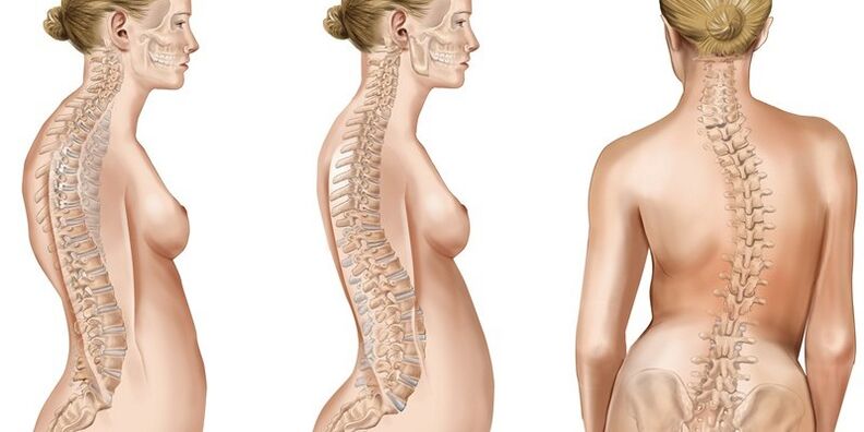 Scoliosis of the thoracic spine provokes pain in the shoulder blades